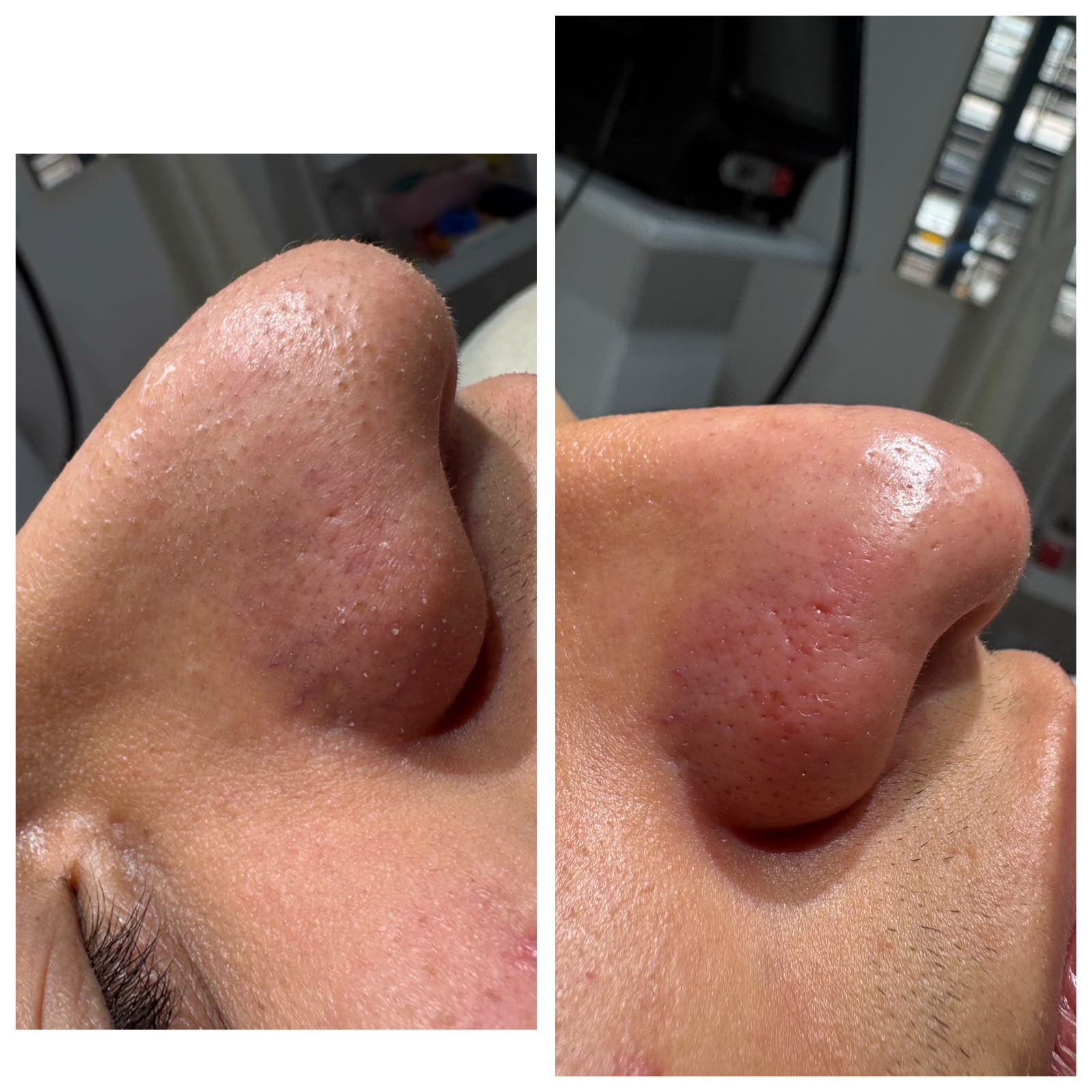 Foto del servicio LIMPIEZA FACIAL HIDRAFACIAL