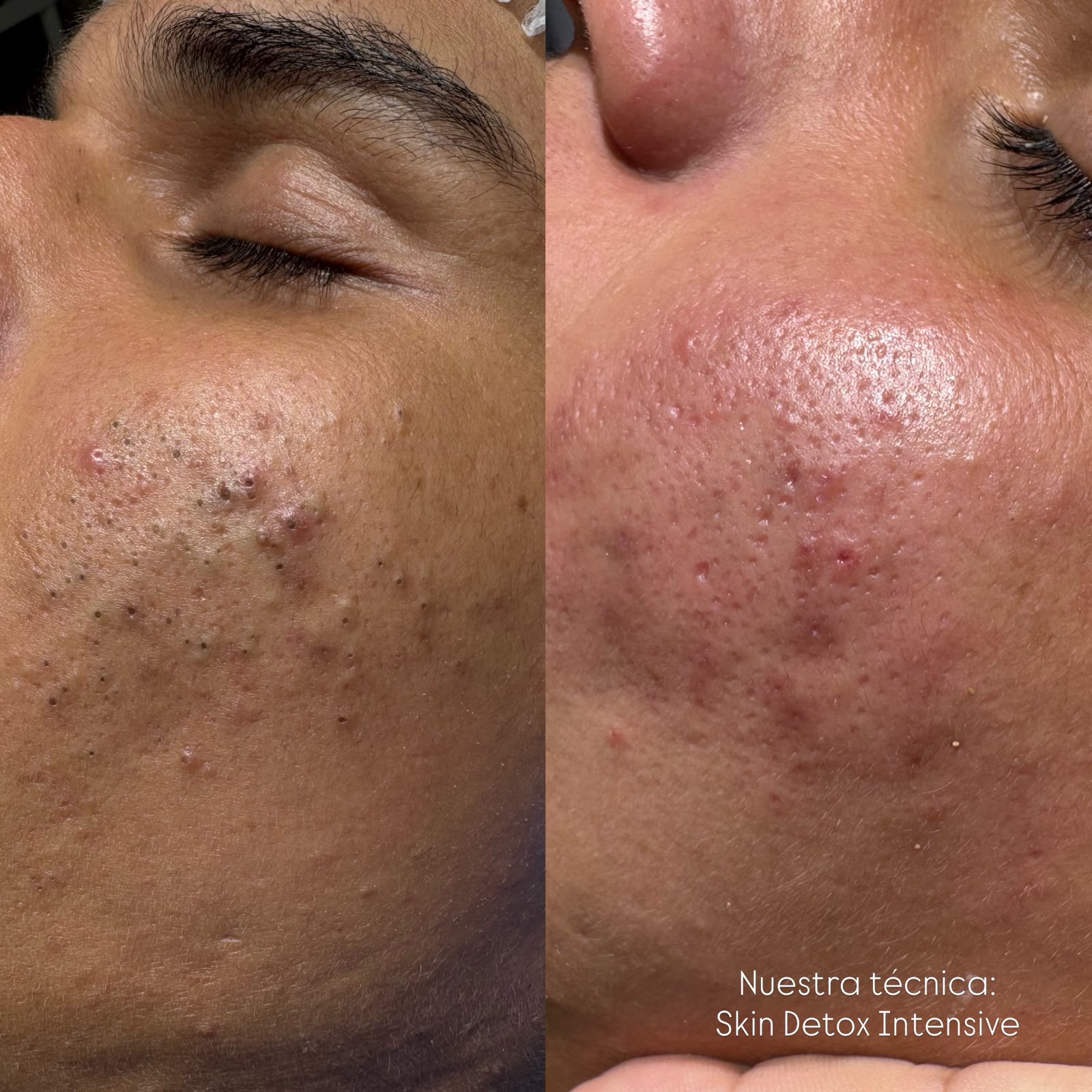 Foto del servicio LIMPIEZA FACIAL SKIN DETOX