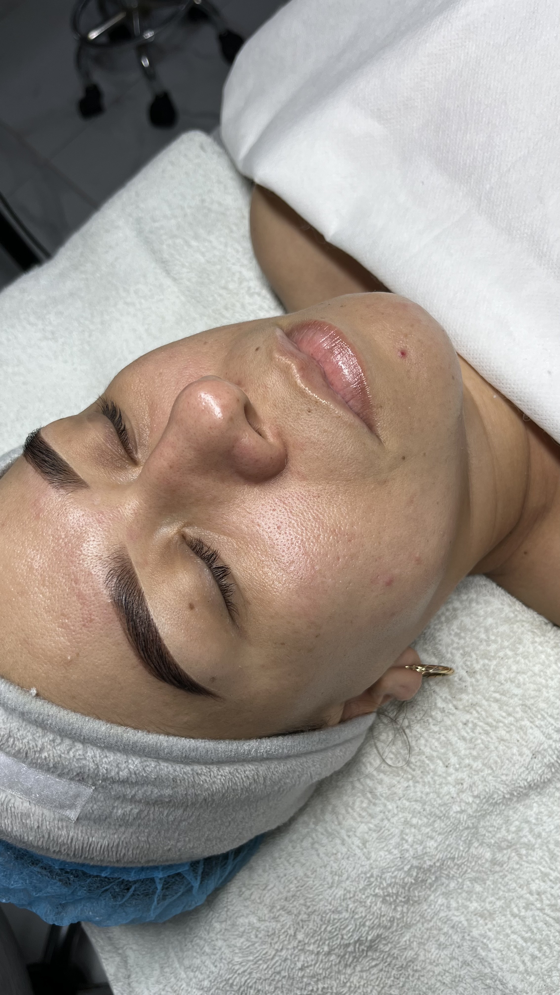 Foto del servicio HIDRAFACIAL