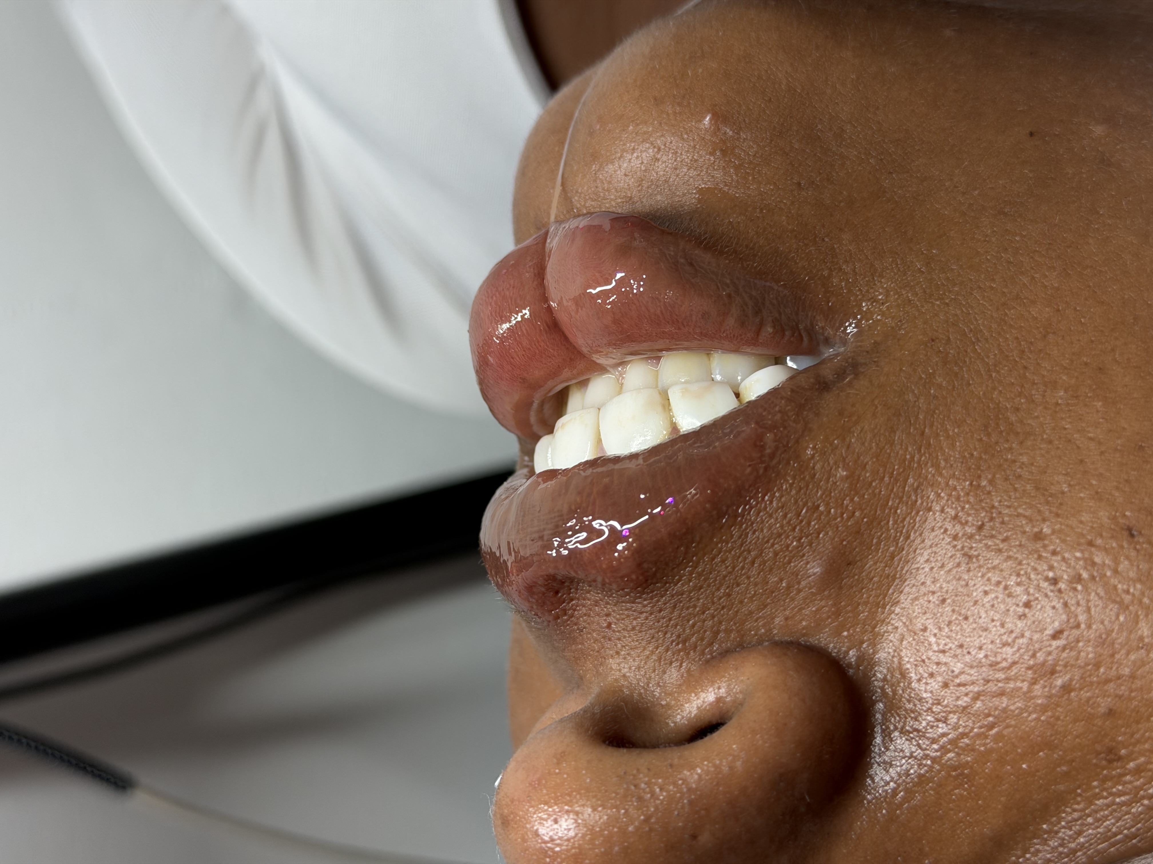 Foto del servicio Aumento de labios 💋