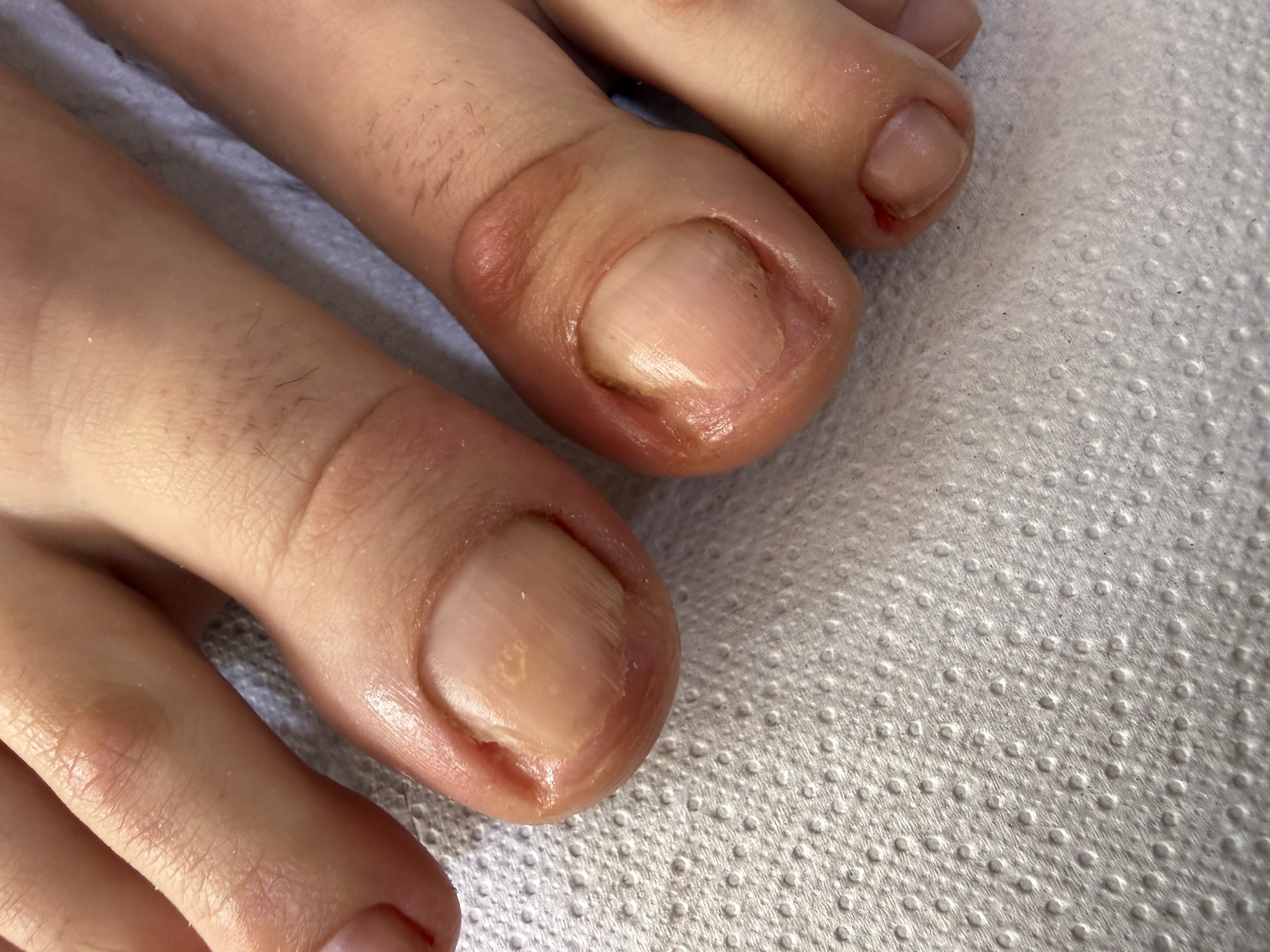 Foto del servicio Tratamiento y eliminación de onicomicosis
